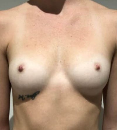 Breast Augmentation Before & After Gallery - Patient 242308 - Image 1