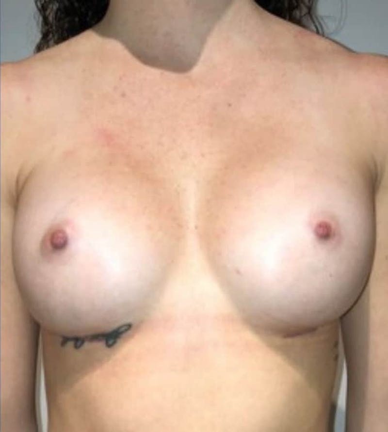 Breast Augmentation Before & After Gallery - Patient 242308 - Image 2