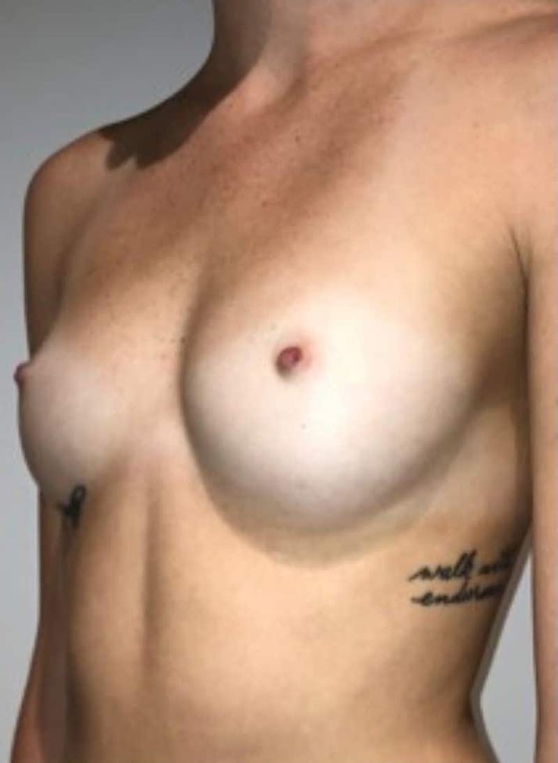 Breast Augmentation Before & After Gallery - Patient 242308 - Image 3