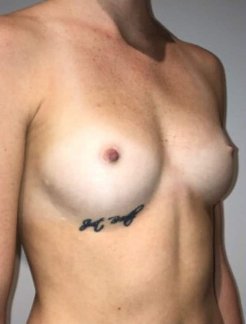 Breast Augmentation Before & After Gallery - Patient 242308 - Image 5