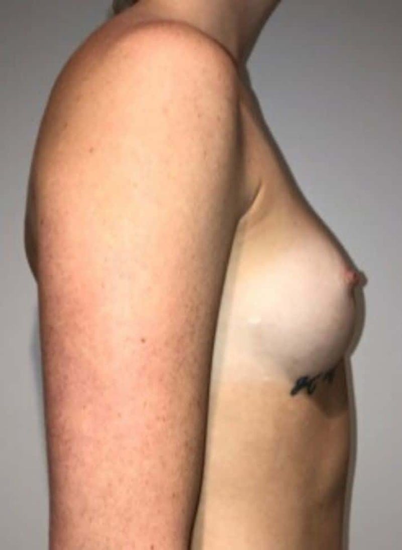 Breast Augmentation Before & After Gallery - Patient 242308 - Image 7