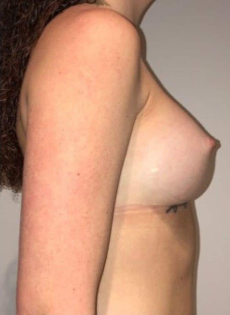 Breast Augmentation Before & After Gallery - Patient 242308 - Image 8