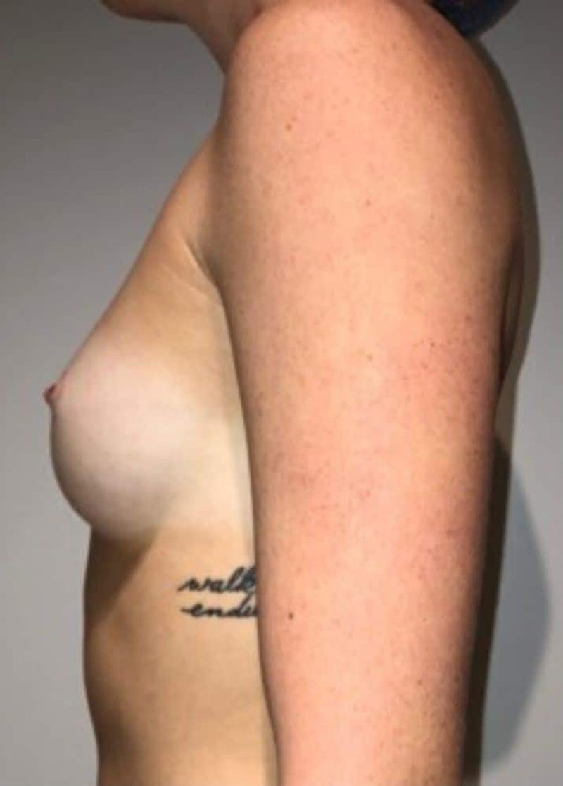 Breast Augmentation Before & After Gallery - Patient 242308 - Image 9