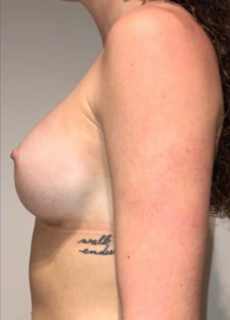 Breast Augmentation Before & After Gallery - Patient 242308 - Image 10