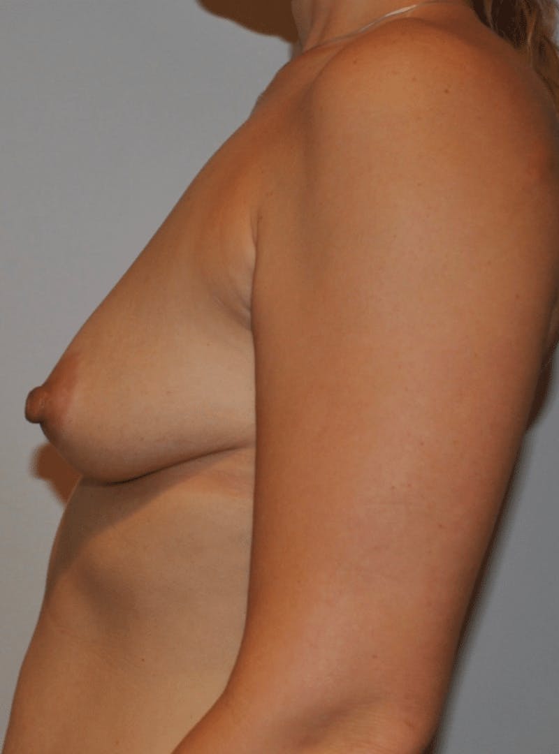 Breast Augmentation Before & After Gallery - Patient 182191 - Image 3