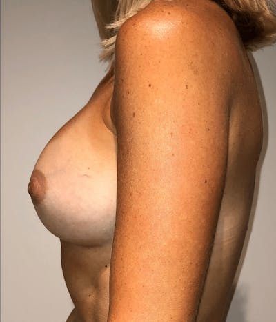 Breast Augmentation Before & After Gallery - Patient 150649 - Image 2