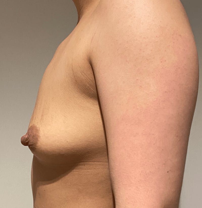 Breast Augmentation Before & After Gallery - Patient 220639 - Image 7