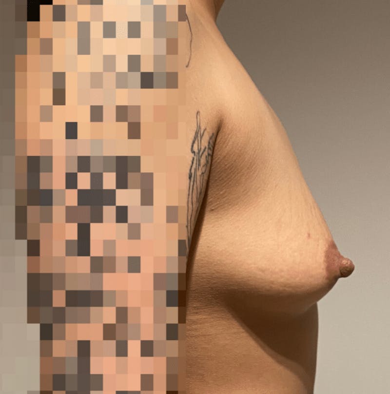 Breast Augmentation Before & After Gallery - Patient 220639 - Image 11