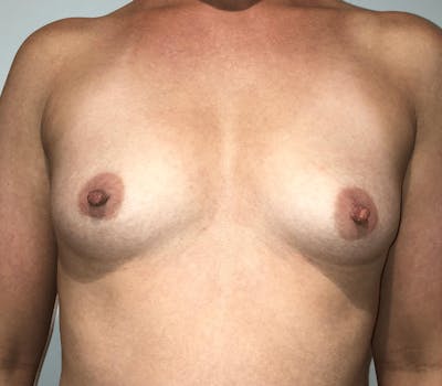 Breast Augmentation Before & After Gallery - Patient 150921 - Image 1