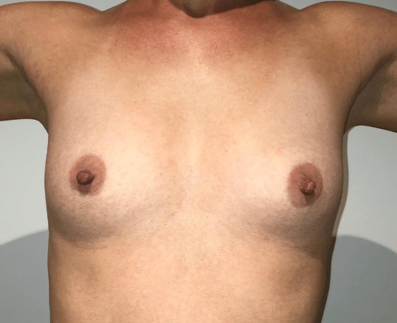Breast Augmentation Before & After Gallery - Patient 150921 - Image 3