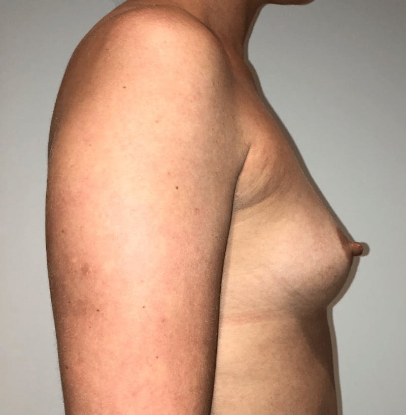 Breast Augmentation Before & After Gallery - Patient 150921 - Image 5