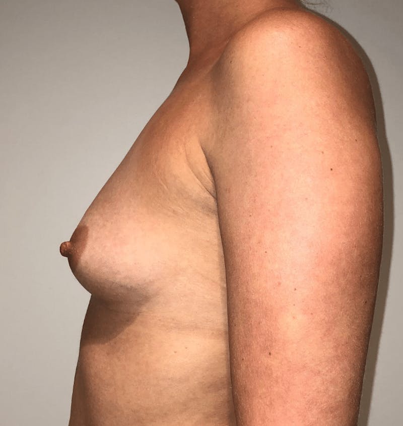 Breast Augmentation Before & After Gallery - Patient 150921 - Image 9