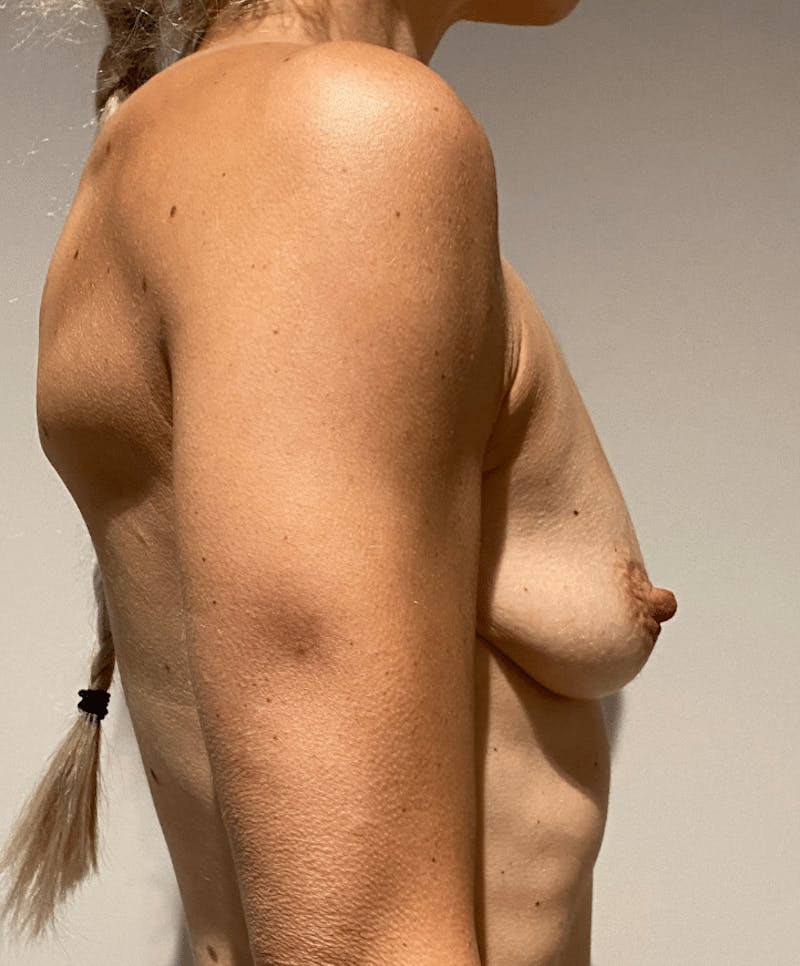 Breast Augmentation Before & After Gallery - Patient 240034 - Image 5