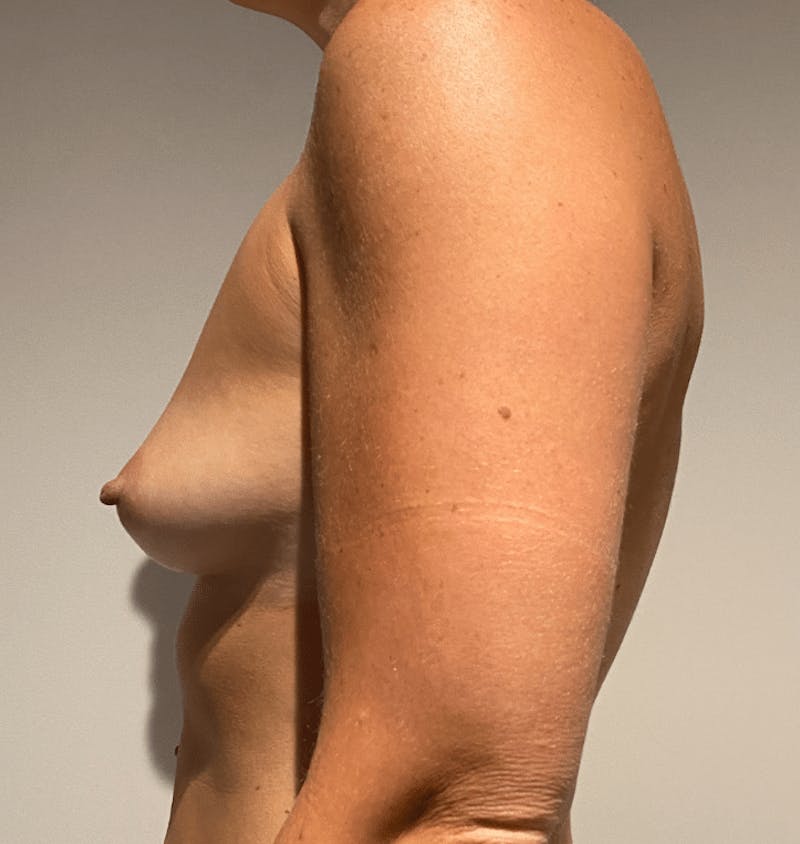Breast Augmentation Before & After Gallery - Patient 422623 - Image 7