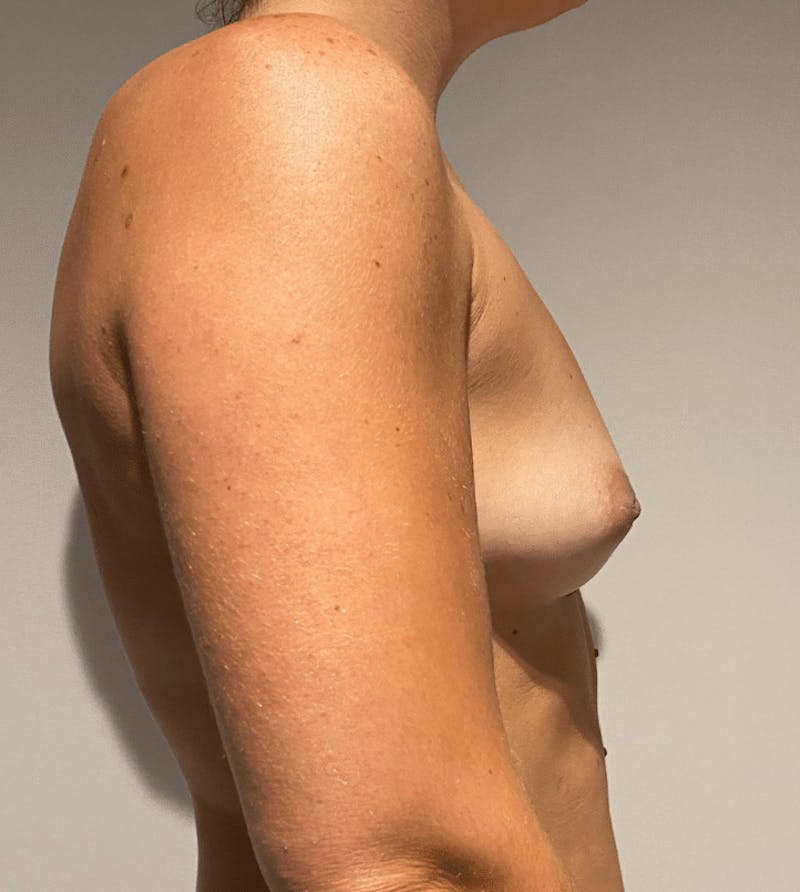 Breast Augmentation Before & After Gallery - Patient 422623 - Image 11