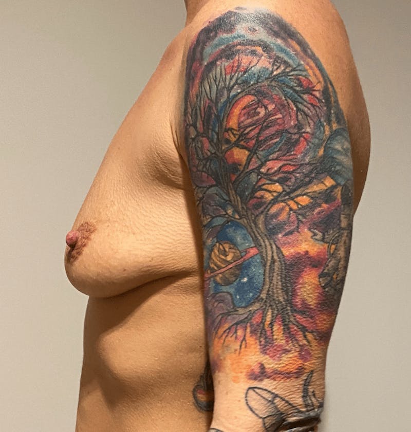 Breast Augmentation Before & After Gallery - Patient 836607 - Image 5