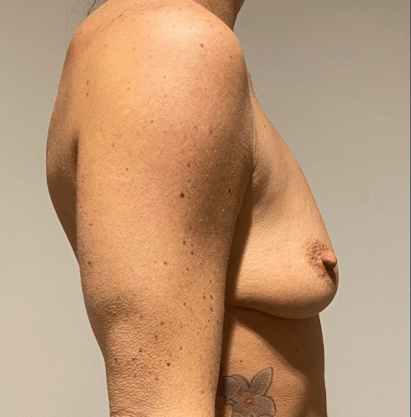 Breast Augmentation Before & After Gallery - Patient 836607 - Image 9