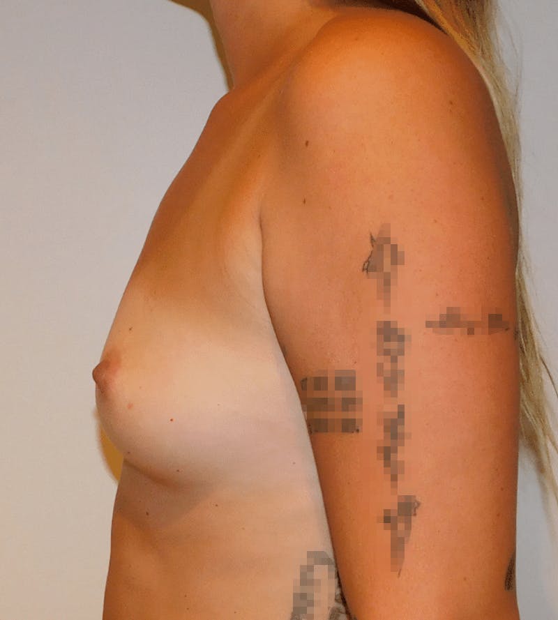 Breast Augmentation Before & After Gallery - Patient 353341 - Image 7