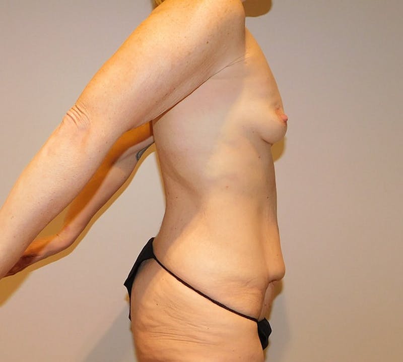 Mommy Makeover Before & After Gallery - Patient 340539 - Image 11