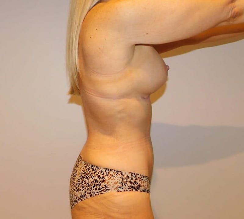 Mommy Makeover Before & After Gallery - Patient 340539 - Image 16
