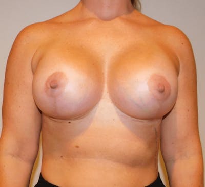 Breast Lift and Reduction Before & After Gallery - Patient 425079 - Image 2