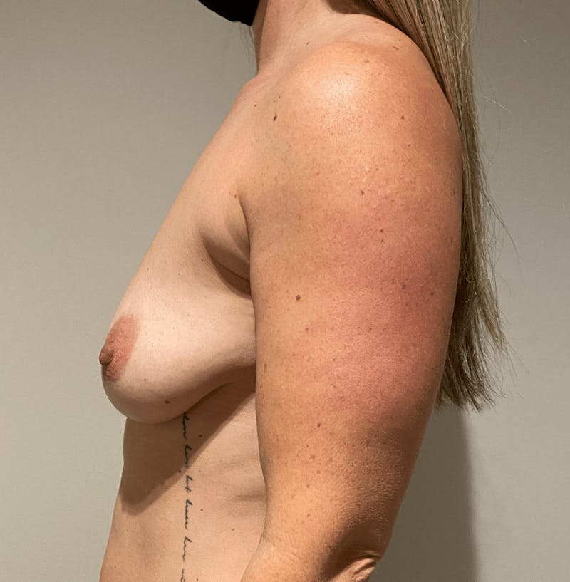 Breast Lift and Reduction Before & After Gallery - Patient 425079 - Image 9