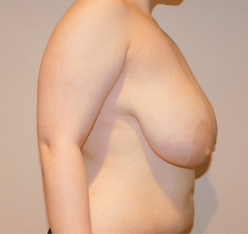 Breast Lift and Reduction Before & After Gallery - Patient 494248 - Image 9