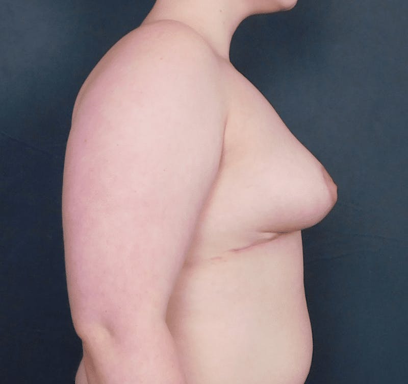 Breast Lift and Reduction Before & After Gallery - Patient 494248 - Image 10