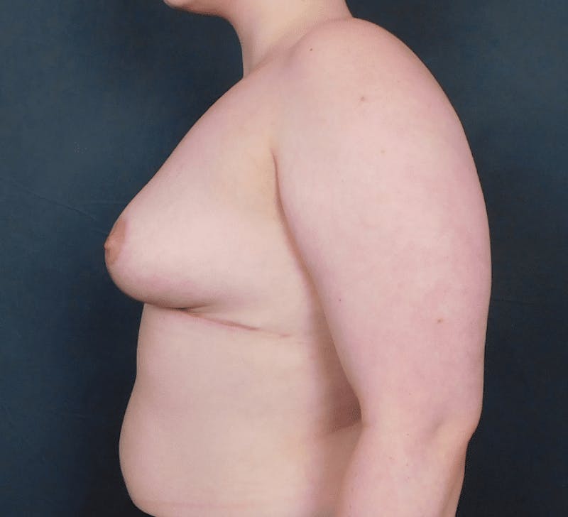 Breast Lift and Reduction Before & After Gallery - Patient 494248 - Image 12