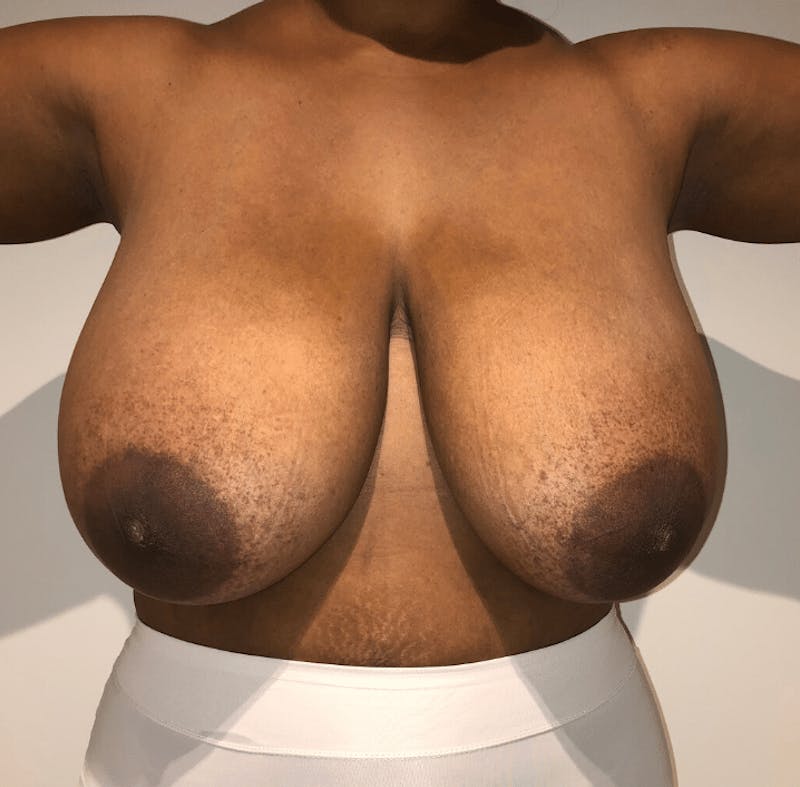 Breast Lift and Reduction Before & After Gallery - Patient 256072 - Image 1
