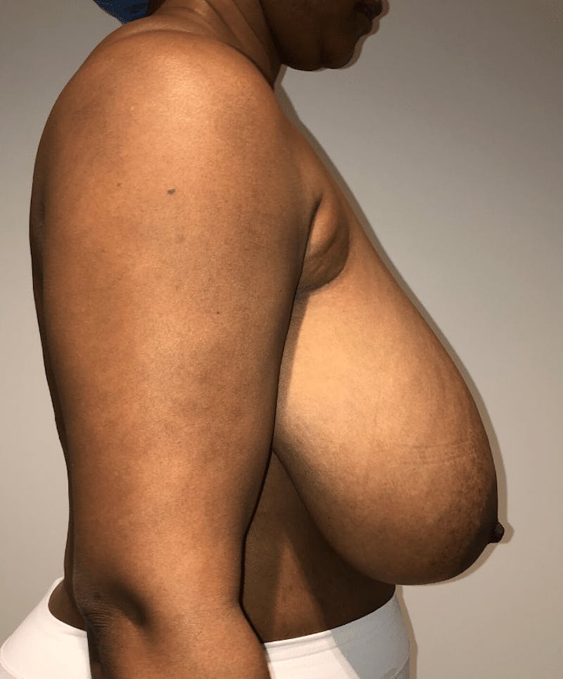 Breast Lift and Reduction Before & After Gallery - Patient 256072 - Image 5