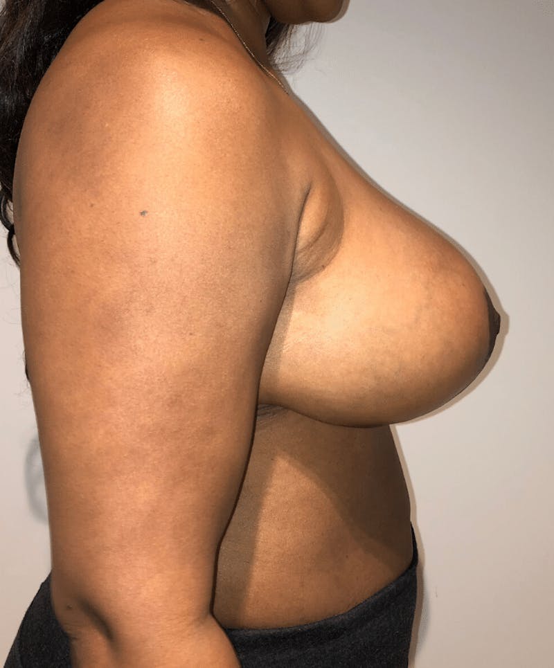 Breast Lift and Reduction Before & After Gallery - Patient 256072 - Image 6