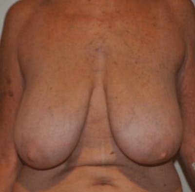 Breast Lift and Reduction Before & After Gallery - Patient 104409 - Image 1