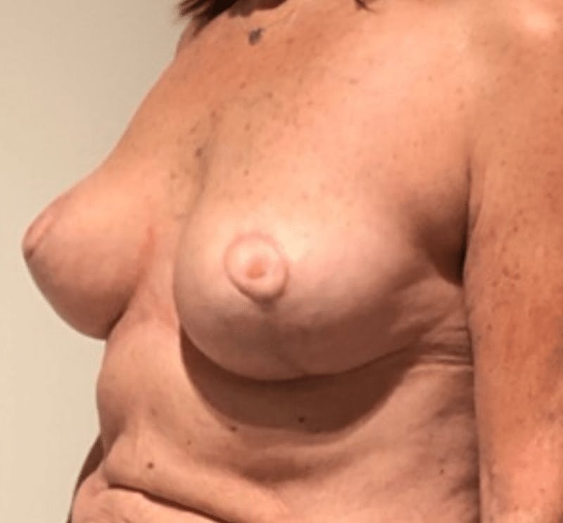 Breast Lift and Reduction Before & After Gallery - Patient 104409 - Image 6
