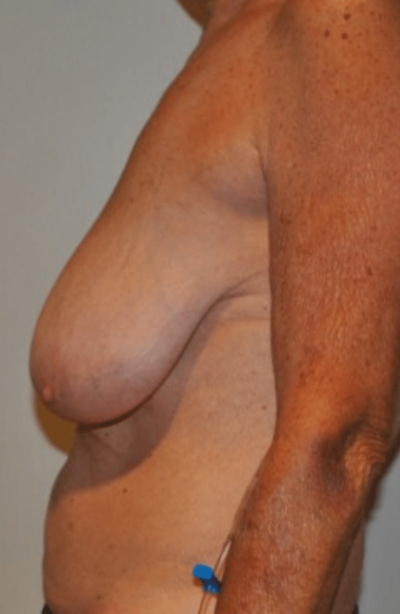 Breast Lift and Reduction Before & After Gallery - Patient 104409 - Image 7