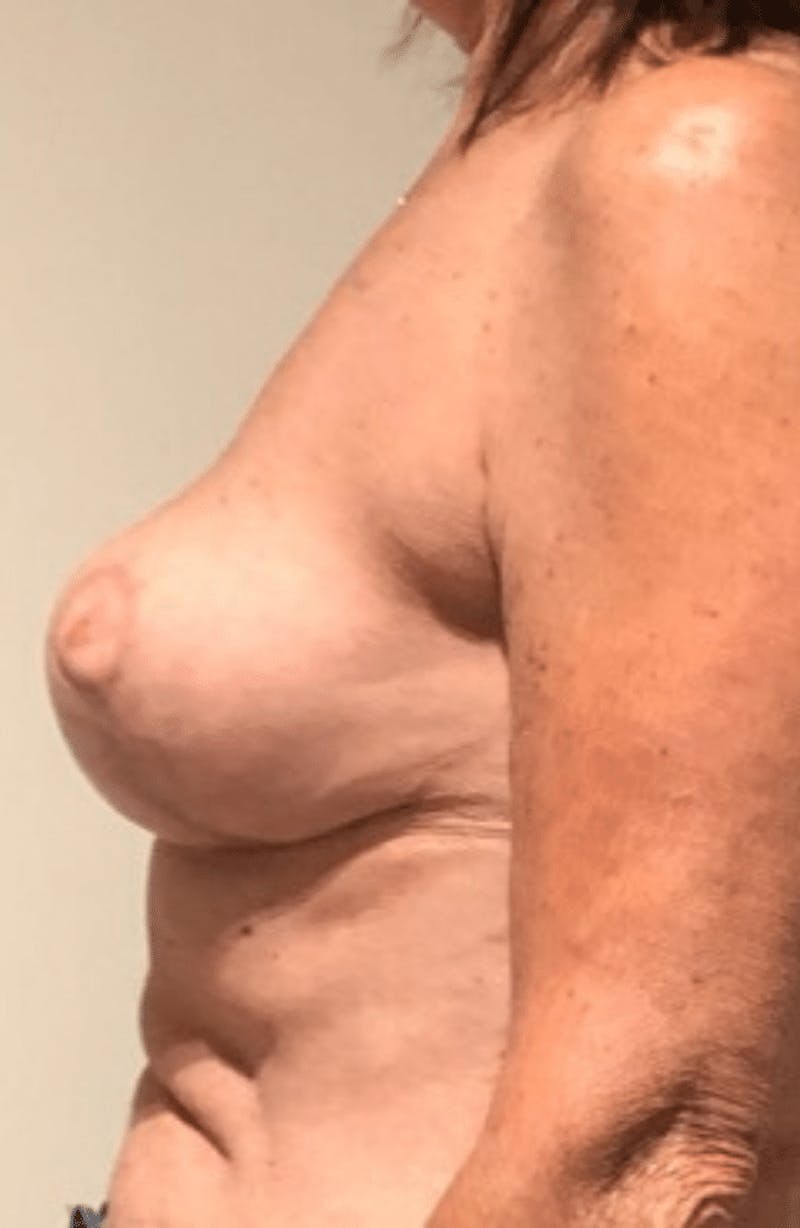 Breast Lift and Reduction Before & After Gallery - Patient 104409 - Image 8
