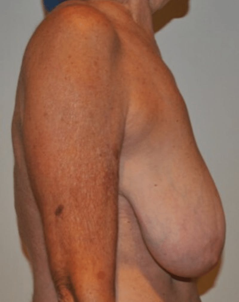 Breast Lift and Reduction Before & After Gallery - Patient 104409 - Image 9
