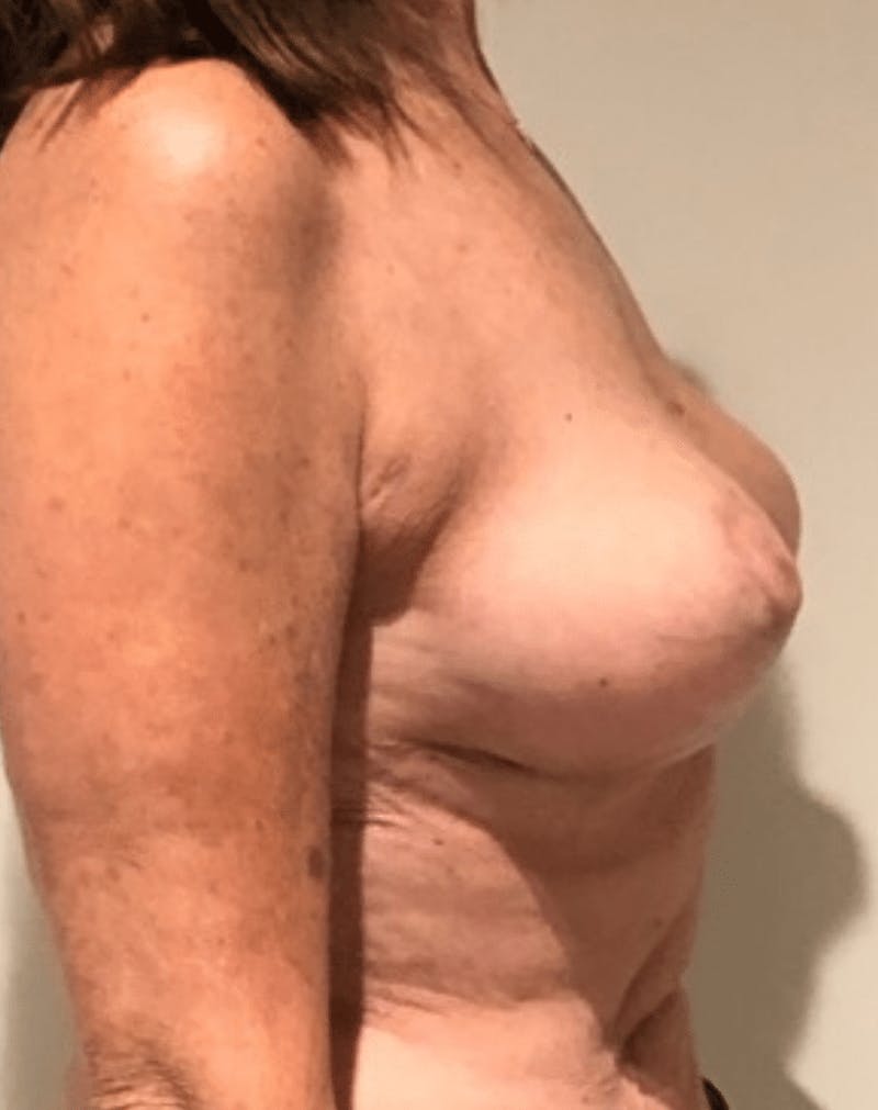 Breast Lift and Reduction Before & After Gallery - Patient 104409 - Image 10