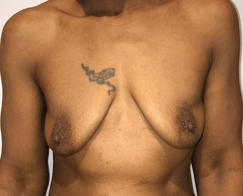 Breast Lift and Reduction Before & After Gallery - Patient 295514 - Image 1