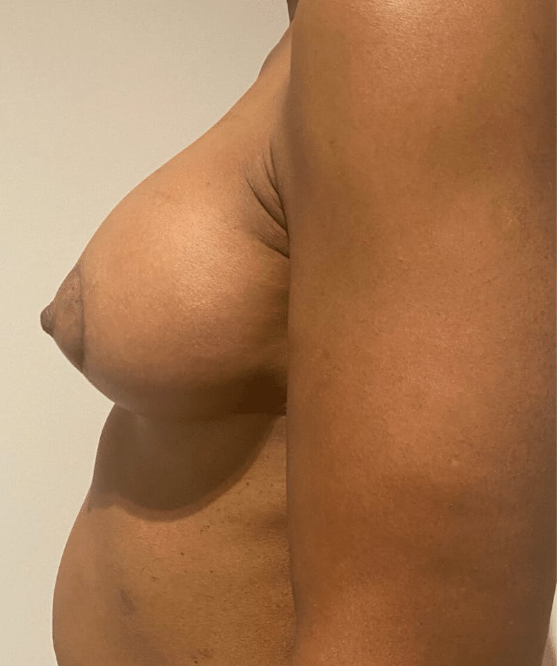 Breast Lift and Reduction Before & After Gallery - Patient 295514 - Image 10