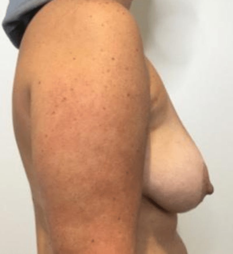Breast Lift and Reduction Before & After Gallery - Patient 259436 - Image 3