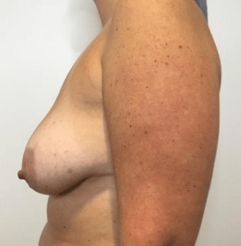 Breast Lift and Reduction Before & After Gallery - Patient 259436 - Image 5