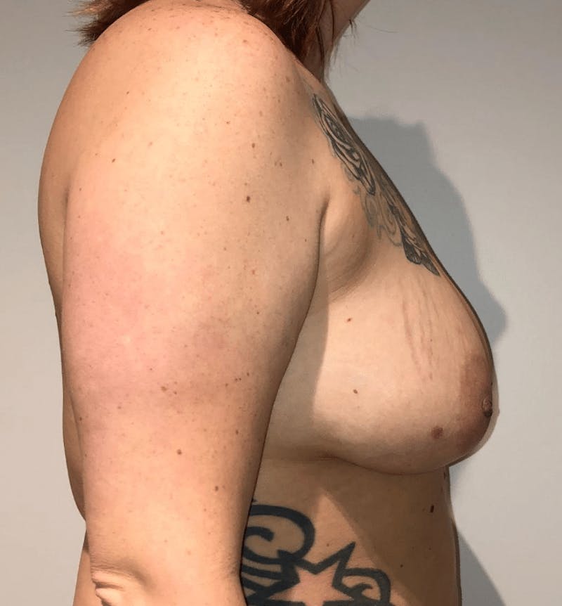 Breast Lift and Reduction Before & After Gallery - Patient 280242 - Image 7