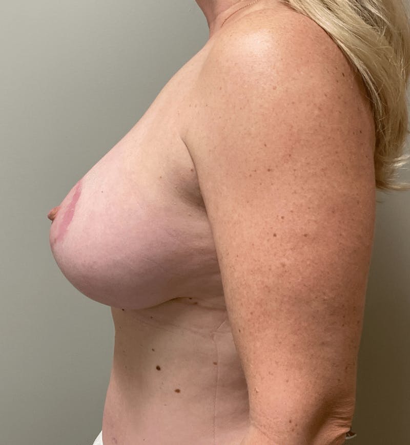 Breast Lift and Reduction Before & After Gallery - Patient 313813 - Image 10