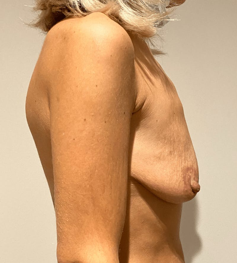 Breast Lift and Reduction Before & After Gallery - Patient 215870 - Image 1
