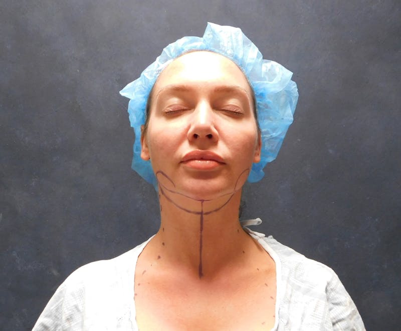 Liposuction Before & After Gallery - Patient 345373 - Image 1