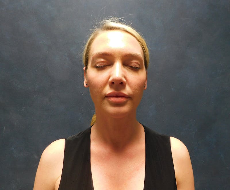 Liposuction Before & After Gallery - Patient 345373 - Image 2