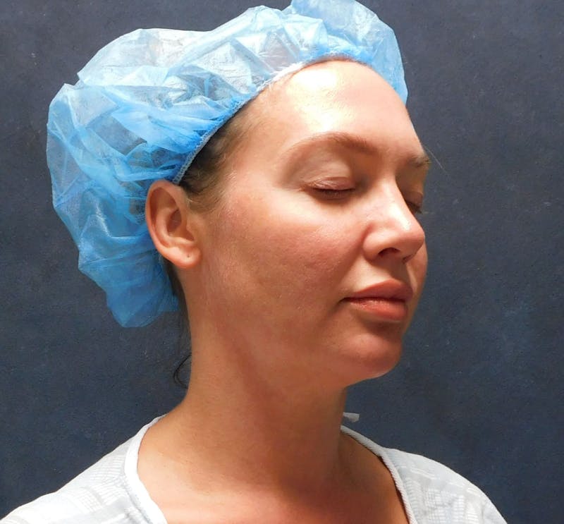Liposuction Before & After Gallery - Patient 345373 - Image 3