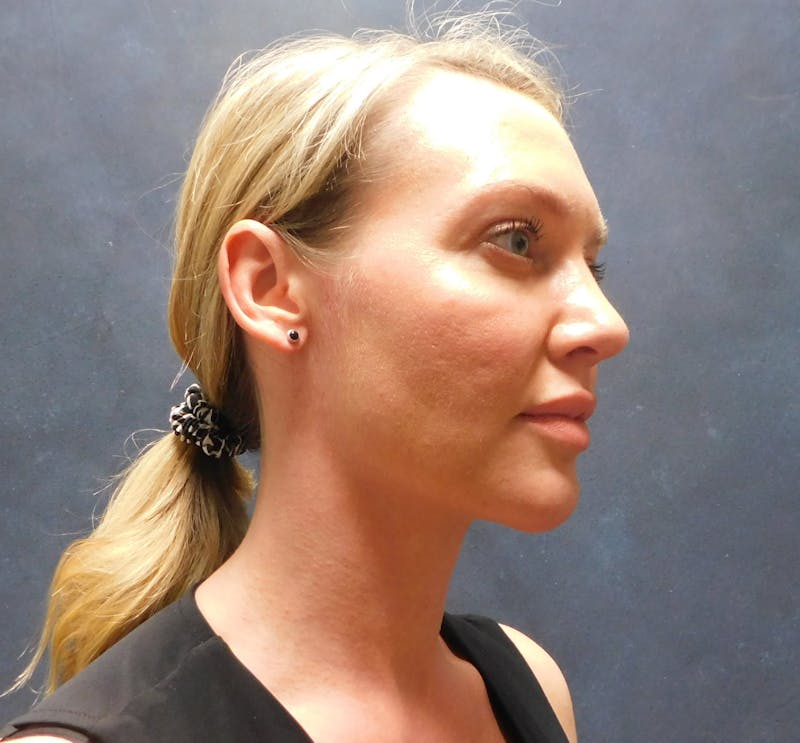 Liposuction Before & After Gallery - Patient 345373 - Image 4