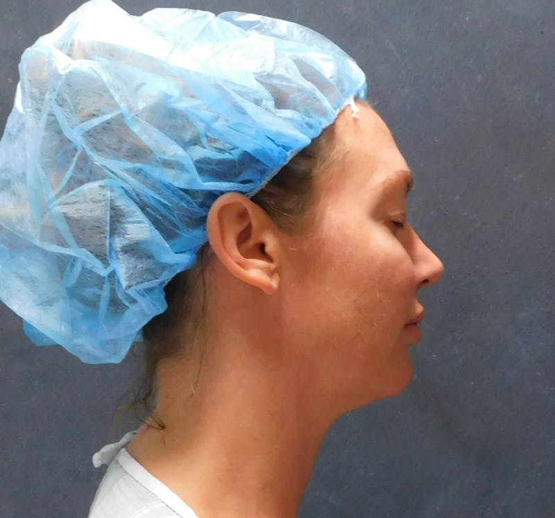 Liposuction Before & After Gallery - Patient 345373 - Image 5